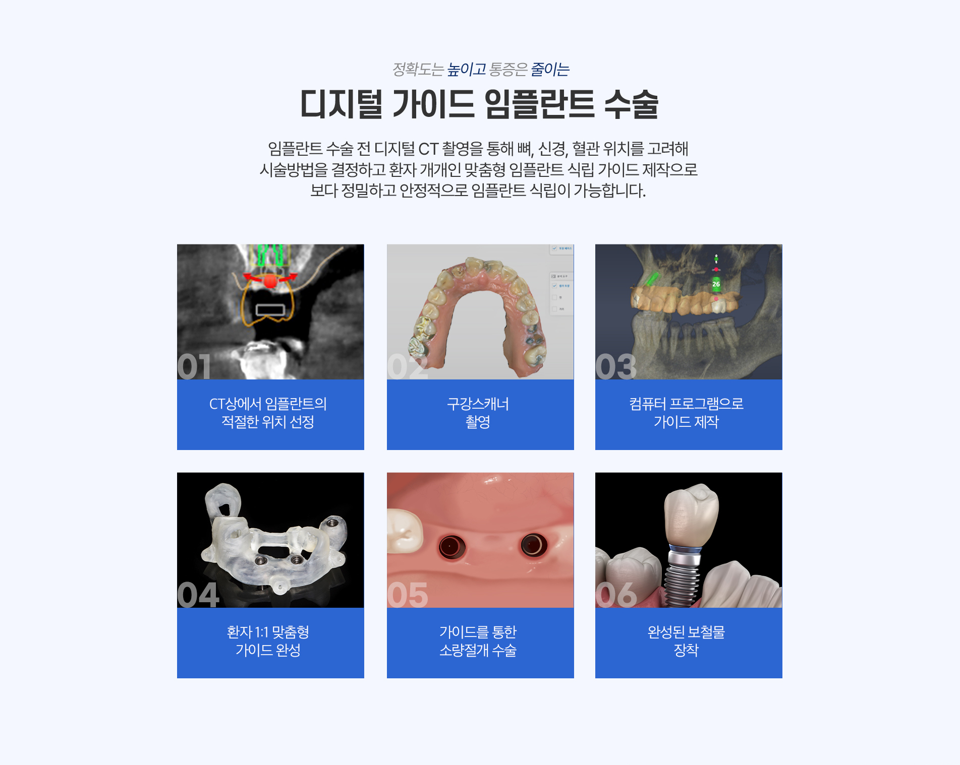 CT 위치 선정, 구강 스캔, 컴퓨터 설계, 맞춤 가이드, 소량 절개, 보철 장착의 디지털 가이드 임플란트 과정을 설명하는 이미지