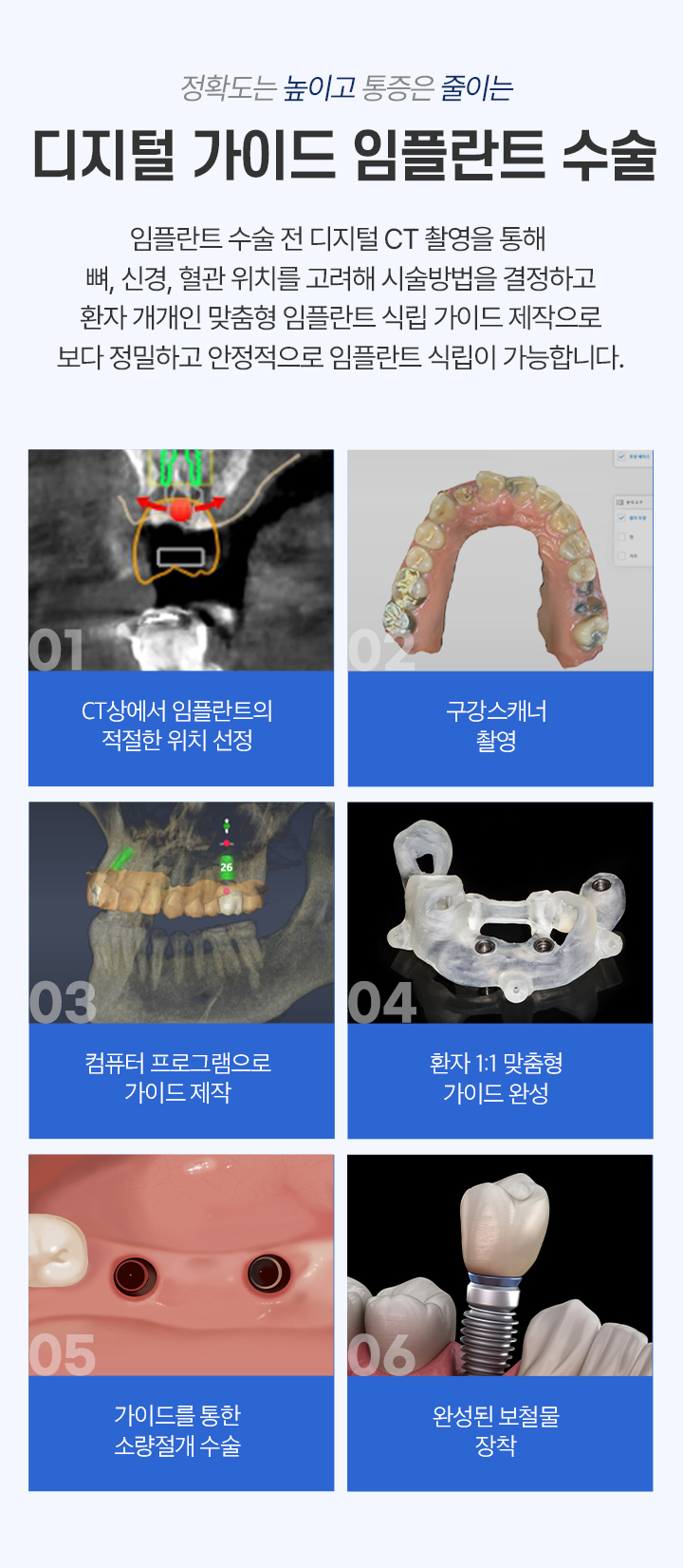 CT 위치 선정, 구강 스캔, 컴퓨터 설계, 맞춤 가이드, 소량 절개, 보철 장착의 디지털 가이드 임플란트 과정을 설명하는 이미지