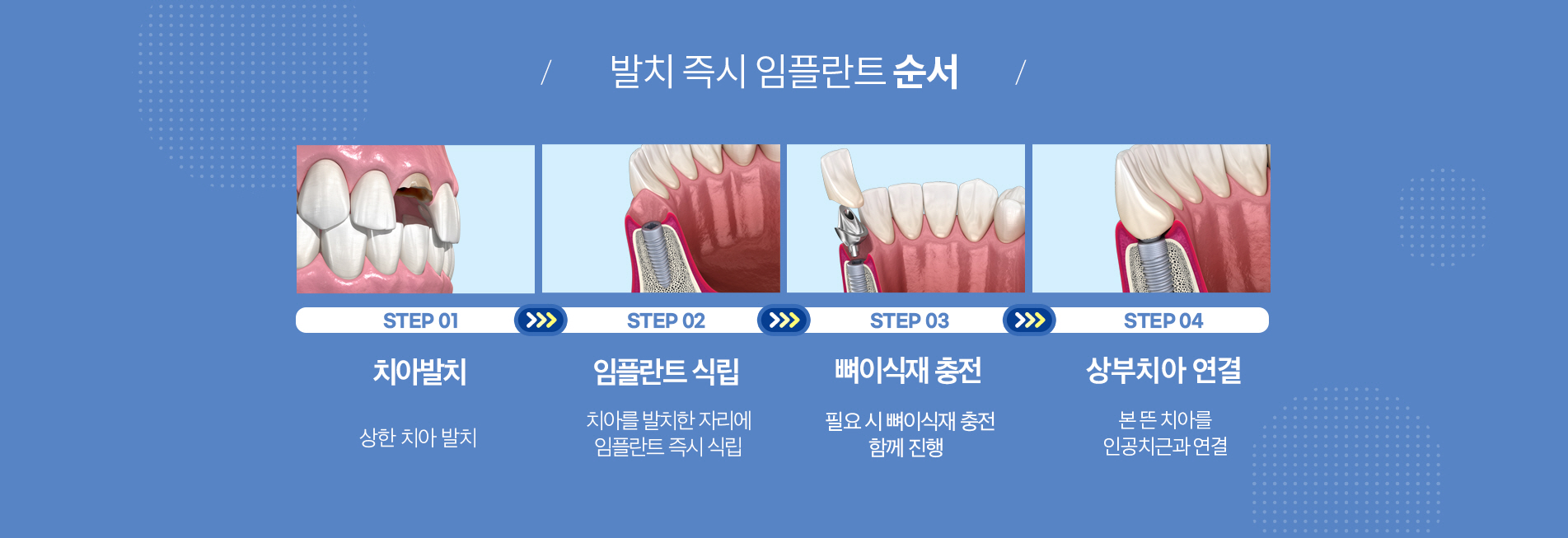 발치 즉시 임플란트 진료 안내 이미지 2: 기대할 수 있는 장점. 치료 기간 단축: 발치 후 아무는 기간을 기다리지 않아 전체 일정이 짧아질 수 있습니다. 수술 횟수 감소: 발치와 식립을 한 번에 진행해 수술 부담을 줄입니다. 잇몸 형태 보존: 발치 직후 식립으로…
