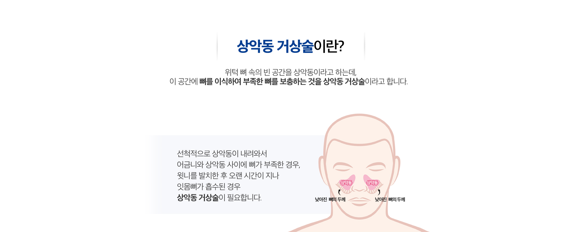 상악동 거상술 진료 안내 이미지 1: 상악동 거상술. 위쪽 어금니 부위의 뼈가 부족할 때, 상악동 막을 들어 올리고 뼈를 보강하여 임플란트를 안전하게 식립합니다.