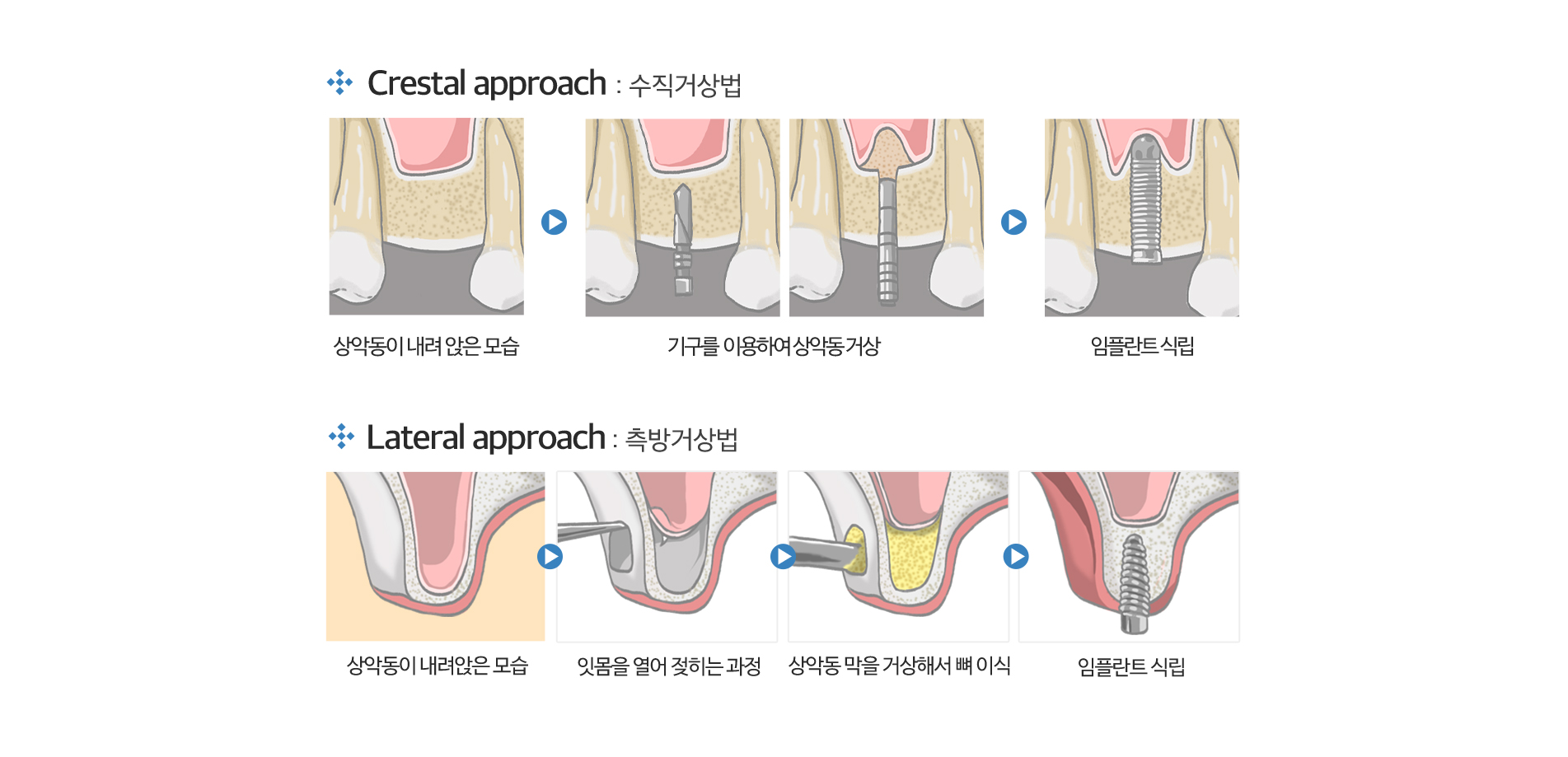 상악동 거상술 진료 안내 이미지 3: 치료 과정. 01 정밀 진단: CT로 상악동 위치와 잔존 뼈 높이를 정밀하게 측정합니다. 02 상악동 거상: 상악동 막을 조심스럽게 들어 올려 공간을 확보합니다. 03 뼈 이식: 확보한 공간에 뼈 이식재를 채워 높이를…