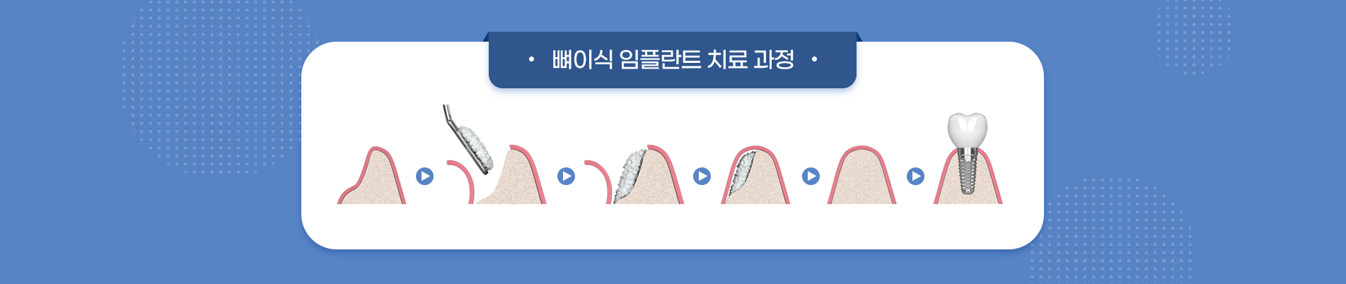 뼈이식 수술 진료 안내 이미지 3: 뼈이식 후 관리 포인트. 처방받은 약을 지시대로 복용하고 지정된 날짜에 내원합니다. 수술 부위를 혀나 손으로 자극하지 않습니다. 흡연은 골 형성을 방해하므로 회복 기간 동안 삼갑니다. 부드러운 음식 위주로 식사하고…