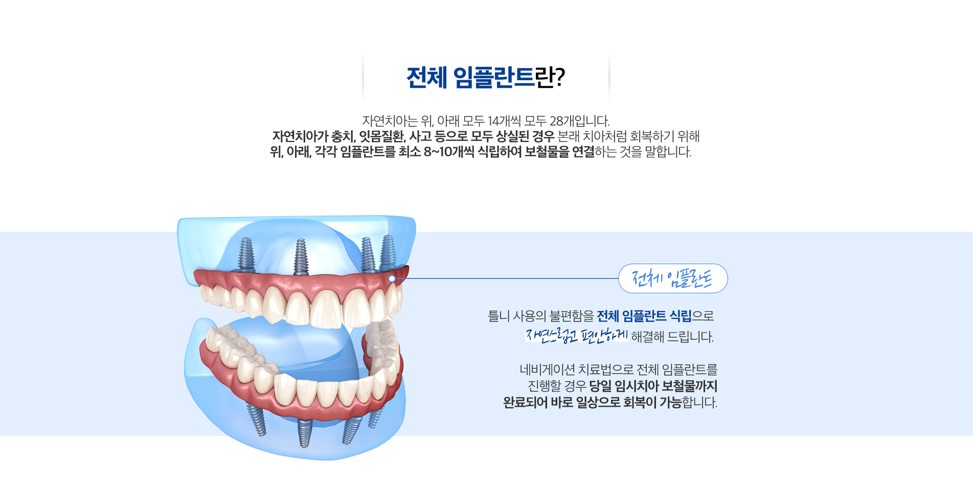 전체 임플란트 진료 안내 이미지 1: 전체 임플란트. 치아가 거의 없거나 전체적으로 상실된 무치악 상태를, 적은 수의 임플란트로 안정적으로 회복합니다.