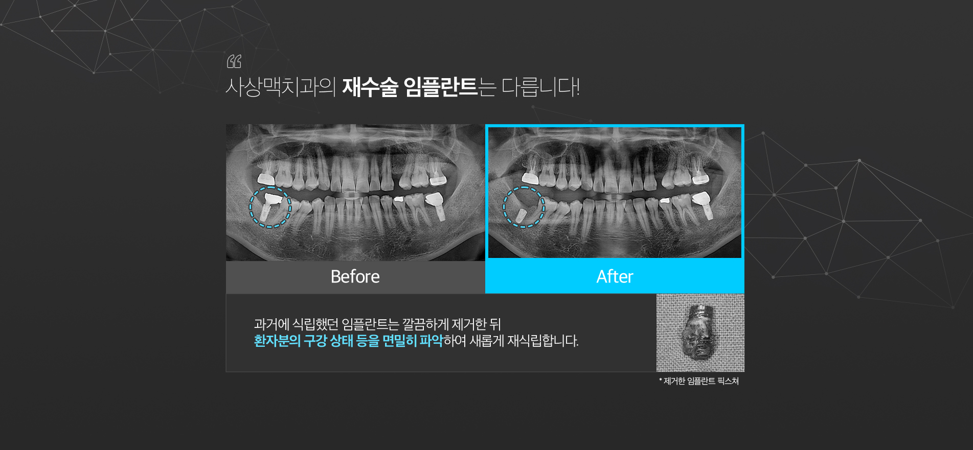 임플란트 재수술 진료 안내 이미지 3: 치료 과정. 01 원인 진단: CT와 검사로 실패 원인과 주위 조직 상태를 정밀하게 파악합니다. 02 제거·염증 처치: 문제가 된 임플란트를 제거하고 염증과 조직을 정리합니다. 03 뼈 회복: 필요 시 뼈이식으로 결손…