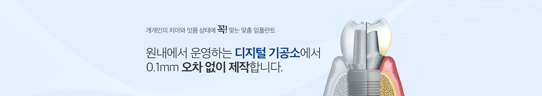 맞춤형 임플란트 보철 진료 안내 이미지 2: 맞춤형 임플란트 보철 주의사항. 임플란트는 진단부터 최종 보철 장착까지 통상 3개월 이상, 골이식이나 상악동 거상술이 동반되는 경우 6개월 이상 치료 기간이 소요될 수 있습니다. 시술 후 염증, 출혈, 부종, 감염, 인접 치아·신경·상악동 손상 등의 부작용이 발생할…