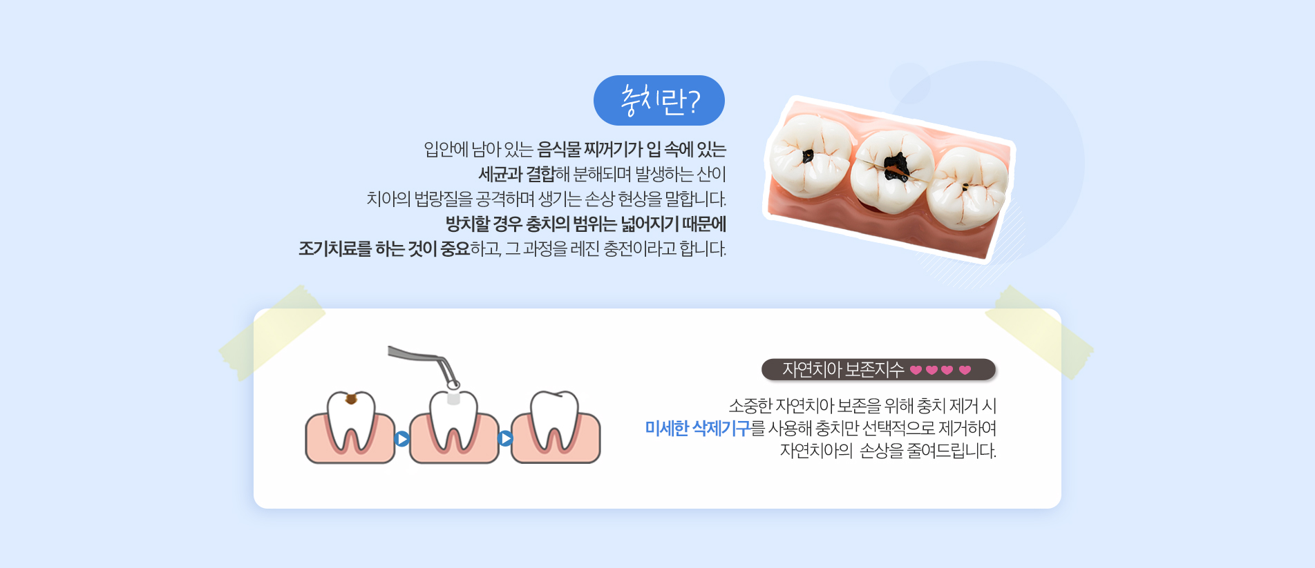 레진 충전 치료 진료 안내 이미지 2: 치료 과정. 01 진단: 육안 및 방사선 검사로 충치의 깊이와 범위를 확인합니다. 02 충치 제거: 감염된 조직을 선택적으로 삭제하고 접착 면을 다듬습니다. 03 레진 충전: 층을 나누어 레진을 채우고 특수 광으로…