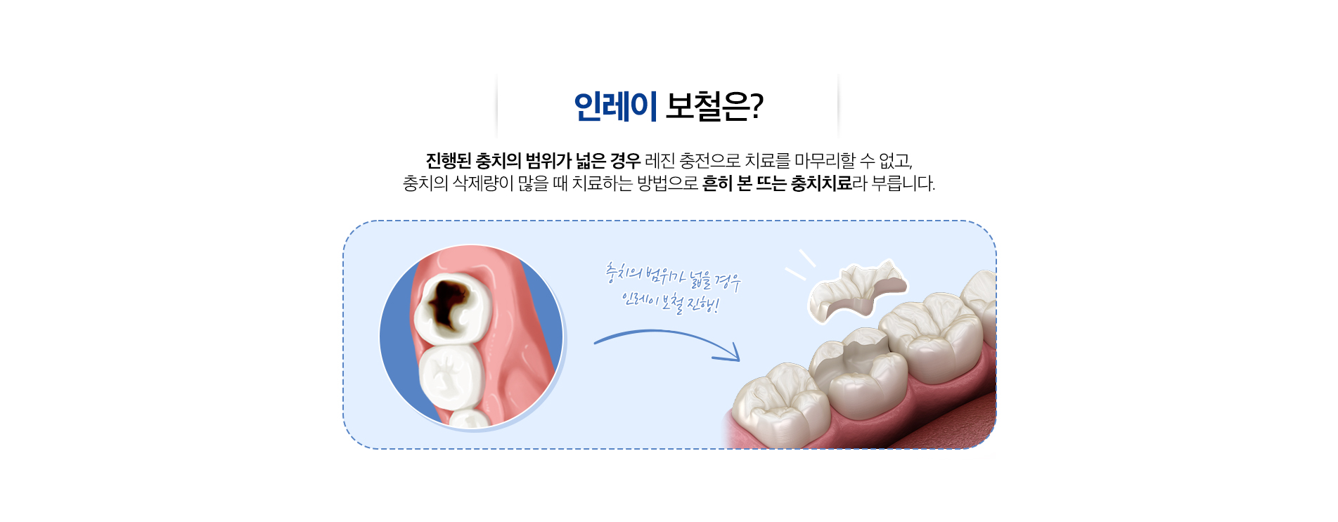 인레이 보철 치료 진료 안내 이미지 1: 인레이 보철 치료. 충치 범위가 넓어 레진만으로 부족할 때, 본을 떠 제작한 보철물로 정밀하게 수복하는 간접 충전 방식입니다.