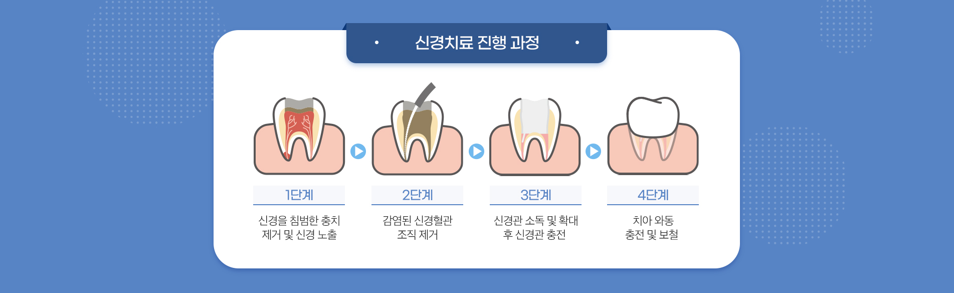 신경치료 진료 안내 이미지 2: 이런 증상이면 신경치료가 필요할 수 있습니다. 찬물이나 뜨거운 것에 오래 지속되는 시림과 통증 아무 자극이 없어도 욱신거리는 자발통 밤에 심해지는 통증으로 잠을 이루기 어려움 치아를 두드리거나 씹을 때 느껴지는 통증…