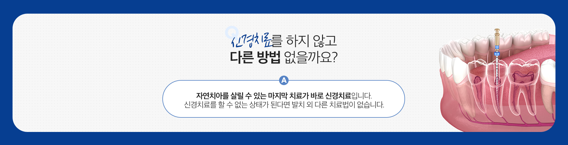 신경치료 진료 안내 이미지 4: 신경치료 주의사항. 치료 후 며칠간 씹을 때 불편감이나 둔통이 있을 수 있으며 대개 시간이 지나며 완화됩니다. 신경치료를 마친 치아는 약해지므로 크라운 등 보철로 보호하지 않으면 파절 위험이 높아집니다. 감염이 심하거나 신경관 형태가 복잡한 경우 치료가 길어지거나 발치가…