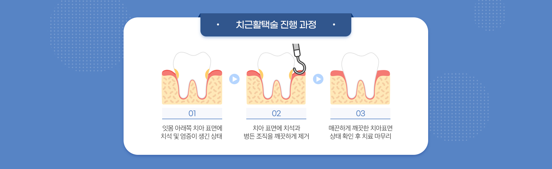 치근활택술 진료 안내 이미지 3: 스케일링과의 차이. 구분 / 스케일링 / 치근활택술 대상 부위 / 잇몸 위 치아 면 / 잇몸 속 뿌리 면 목적 / 예방·기본 관리 / 진행된 치주 질환 치료 마취 / 대개 불필요 / 부위에 따라 필요