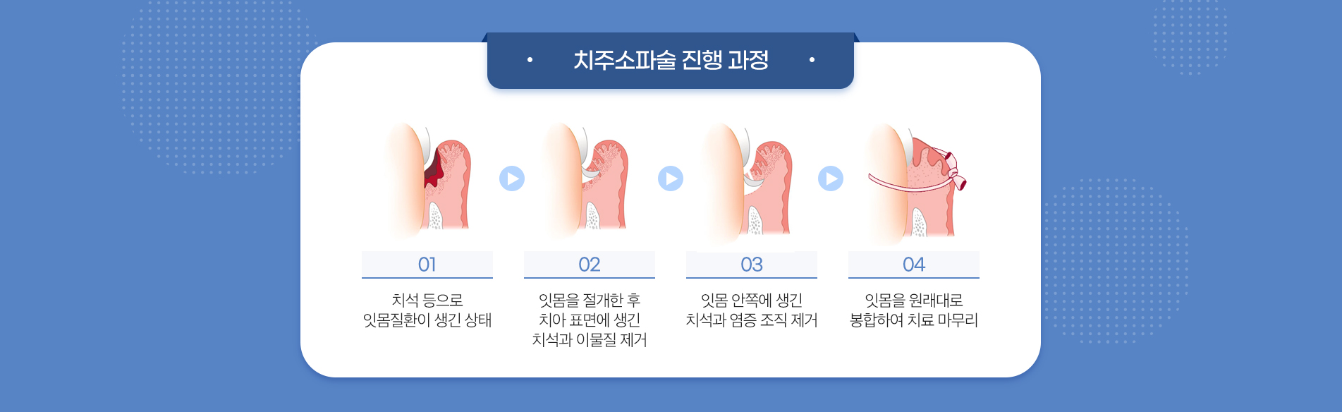 치주소파술 진료 안내 이미지 3: 치료 후 관리 요령. 치료 당일은 자극적이거나 뜨거운 음식을 피합니다. 처방받은 약과 가글은 안내에 따라 사용합니다. 부드러운 칫솔로 자극을 줄이며 위생을 유지합니다. 흡연은 잇몸 회복을 늦추므로 삼가는 것이 좋습니다.…