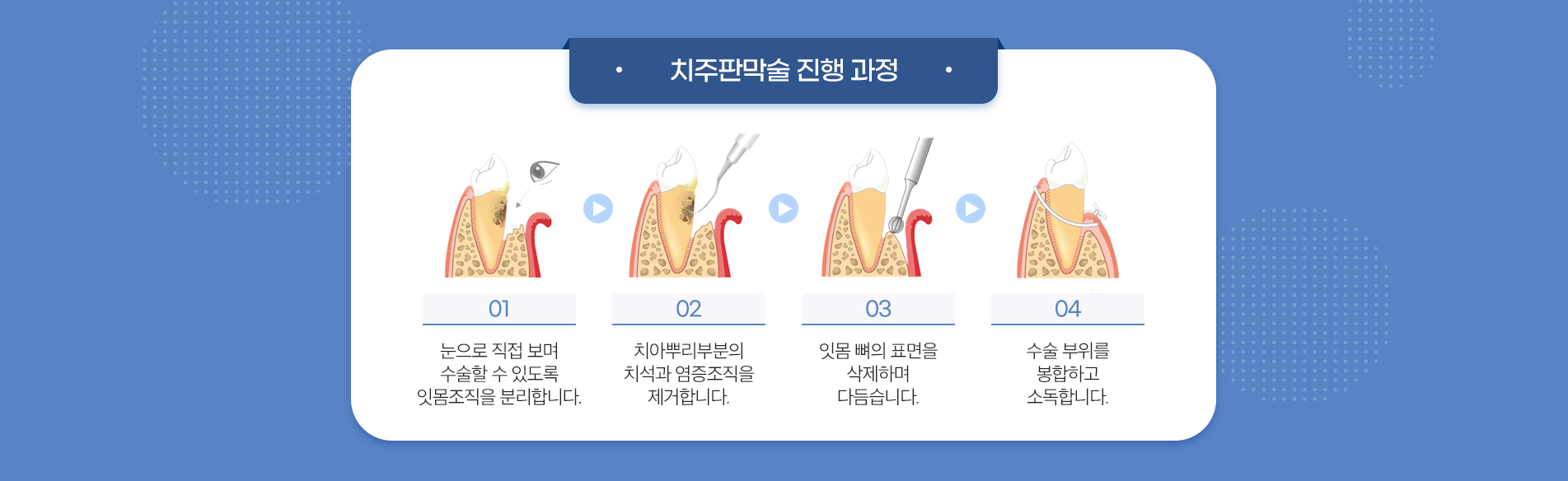 치주판막술 진료 안내 이미지 3: 자주 묻는 질문. 질문: 치주판막술은 많이 아픈가요? 답변: 수술은 국소 마취 하에 진행되어 시술 중 통증은 크지 않습니다. 마취가 풀린 뒤 붓기와 불편감이 있을 수 있으며 처방약으로 관리합니다. 질문: 실밥은 언제…