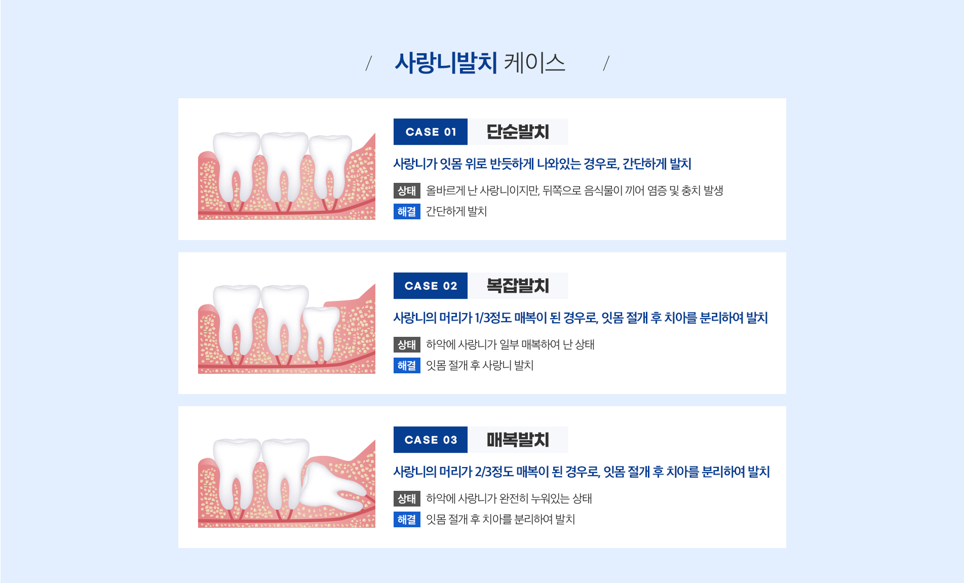 사랑니 발치 진료 안내 이미지 3: 발치 후 관리 안내. 거즈는 2시간가량 꼭 물어 지혈하고, 첫날은 침을 자주 뱉지 않습니다. 당일에는 빨대 사용·격한 양치·흡연·음주를 피해주세요. 얼음찜질로 붓기를 완화하고 처방된 약을 시간에 맞춰 복용합니다.…