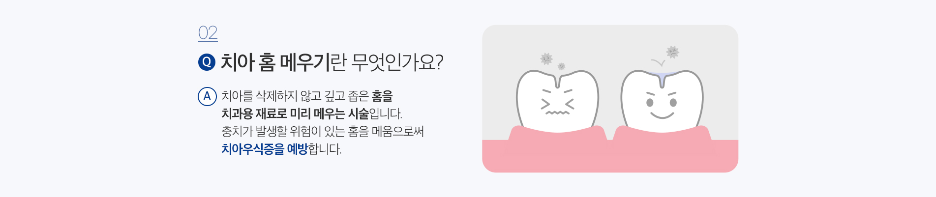 소아치료 진료 안내 이미지 4: 실란트 진행 과정. 01 치아 청결: 실란트를 적용할 어금니를 깨끗이 세척합니다. 02 표면 처리: 접착이 잘 되도록 치아 표면을 처리하고 건조합니다. 03 홈 메우기: 깊은 홈에 실란트를 채우고 빛으로 굳혀 코팅합니다.…