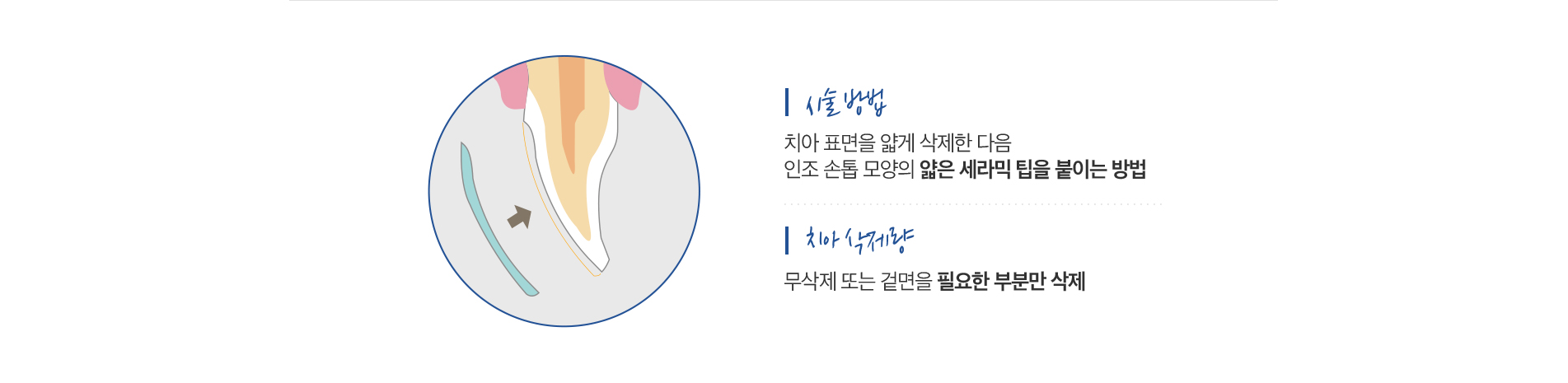 라미네이트 진료 안내 이미지 2: 라미네이트를 고려하는 경우. 치아 변색: 미백으로 개선되지 않는 착색이나 테트라사이클린 변색. 벌어진 앞니: 앞니 사이 틈(치간 이개)을 자연스럽게 메우고 싶을 때. 작거나 마모된 치아: 치아 길이나 크기의 균형을 맞추고…