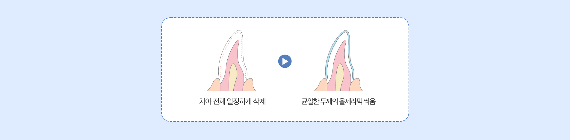 올세라믹 진료 안내 이미지 2: 올세라믹의 특징. 올세라믹은 금속 구조 없이 세라믹만으로 제작하는 크라운으로, 빛의 투과가 자연치아와 비슷해 심미성이 우수합니다. 금속을 쓰지 않아 잇몸 경계가 검게 비치는 현상이 없고, 금속 알레르기 걱정에서도…