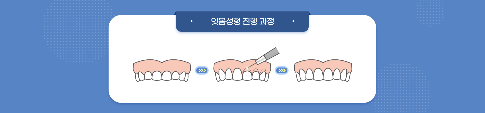 잇몸성형 진료 안내 이미지 2: 이런 경우 고려합니다. 거미스마일: 웃을 때 잇몸이 과하게 드러나 신경 쓰이는 경우. 짧아 보이는 치아: 잇몸이 치아를 많이 덮어 치아가 작아 보이는 경우. 비대칭 잇몸선: 좌우 잇몸 높이가 달라 미소가 불균형해 보이는…