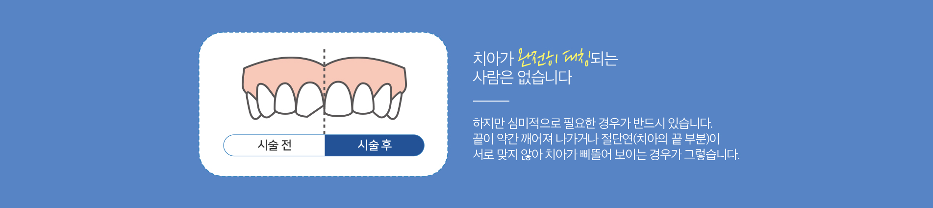 치아성형 진료 안내 이미지 2: 진행 과정. 01 상담·확인: 개선을 원하는 부위와 목표 형태를 함께 확인합니다. 02 형태 조정: 미세 삭제 또는 레진 보완으로 형태를 다듬습니다. 03 연마·마무리: 표면을 매끄럽게 연마해 자연스럽게 마무리합니다.