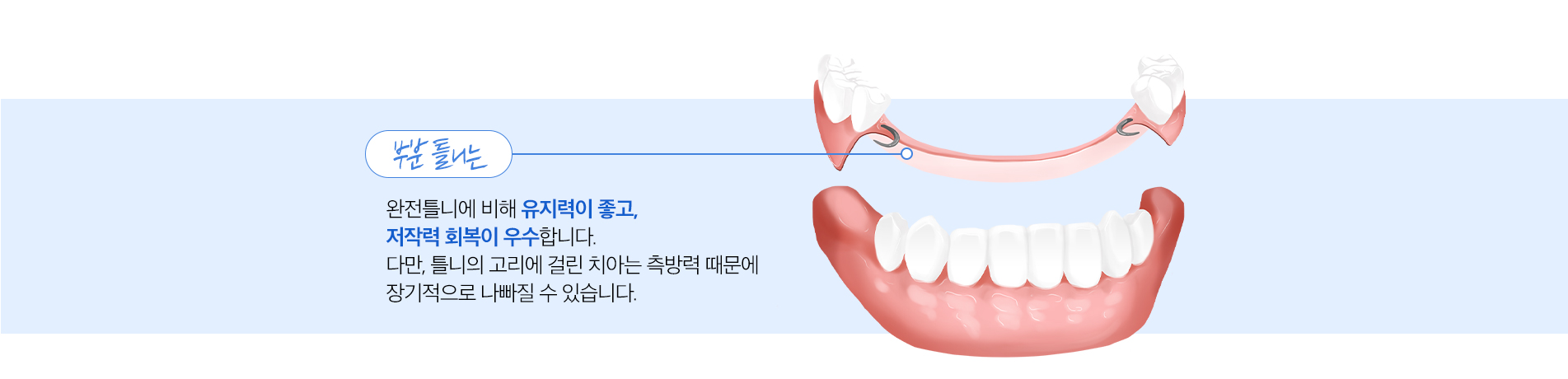 부분 틀니 진료 안내 이미지 2: 부분 틀니란. 부분 틀니는 일부 치아가 남아 있을 때, 남은 치아에 고리(클래스프)나 부착 장치로 고정해 빠진 치아를 대신하는 보철입니다. 치아가 여러 개 빠졌거나 임플란트가 어려운 상황에서 비교적 부담이 적은 방법으로…