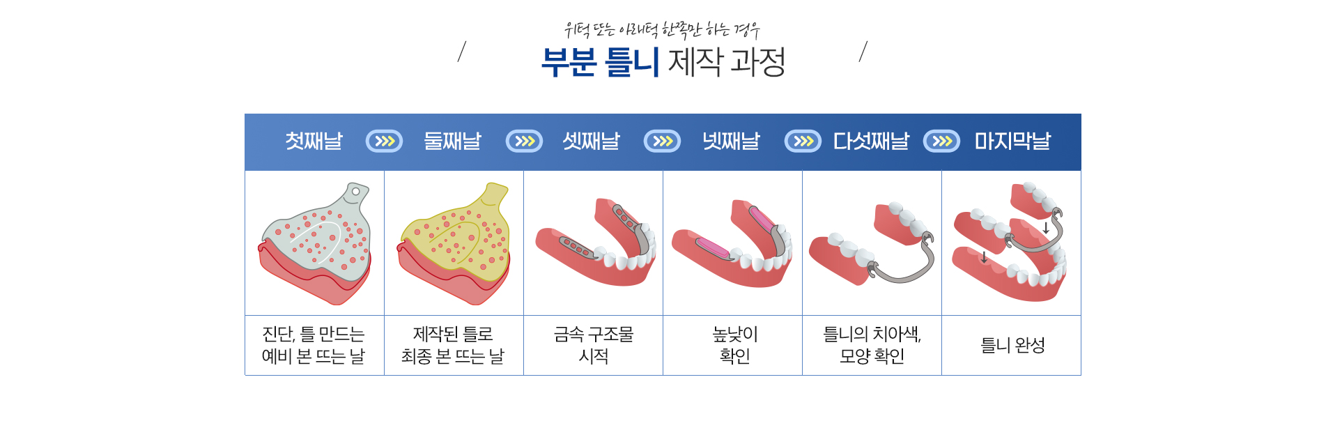 부분 틀니 진료 안내 이미지 3: 진행 과정. 01 진단·설계: 남은 치아 상태를 확인해 지지 방식을 설계합니다. 02 인상·교합: 정밀하게 본을 뜨고 물림을 기록합니다. 03 시적·조정: 틀을 착용해 적합도와 물림을 확인합니다. 04 완성·관리 안내:…