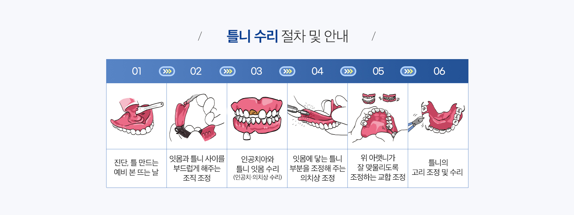 부분 틀니 진료 안내 이미지 4: 사용 시 주의사항. 식후 틀니와 지지대 치아를 함께 깨끗이 닦습니다. 착탈 시 무리하게 힘을 주지 않고 지정된 방향으로 뺍니다. 지지대가 되는 치아는 충치·잇몸병 예방 관리가 특히 중요합니다. 헐거워지거나 통증이 있으면…