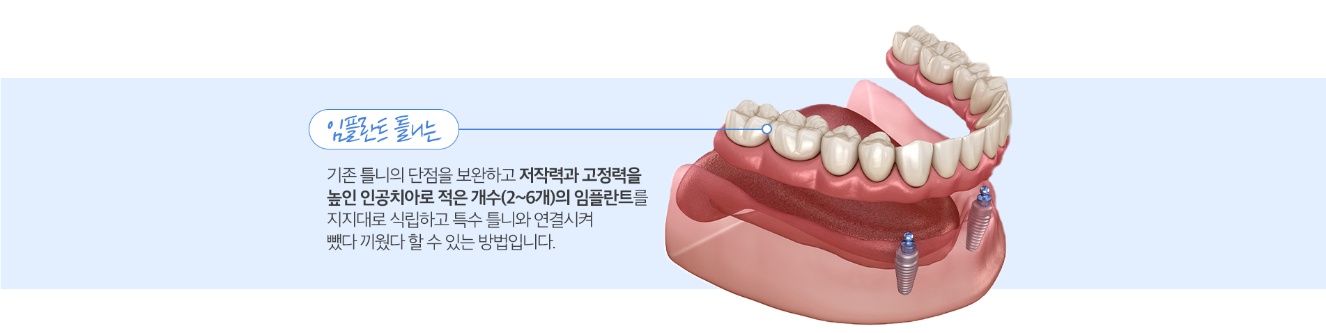 임플란트 틀니 진료 안내 이미지 2: 임플란트 틀니란. 임플란트 틀니(오버덴처)는 잇몸에 심은 소수의 임플란트에 틀니를 연결해 고정력을 높인 보철 방식입니다. 일반 틀니가 자주 헐거워지거나 잇몸뼈 흡수로 밀착이 어려운 경우, 임플란트가 고정점 역할을 해 씹는…